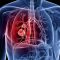Étude : THC et CBD inhibent la prolifération des cellules cancéreuses dans le cancer du poumon