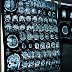 Une étude suggère que le cannabis médical est « sans danger pour le cerveau » des adultes.